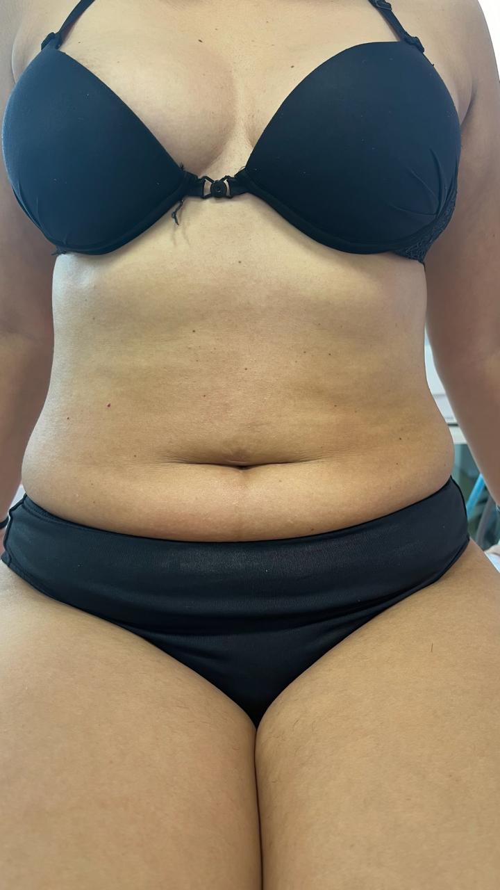 Depois - Diástase abdominal